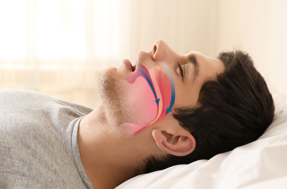 sleep apnea