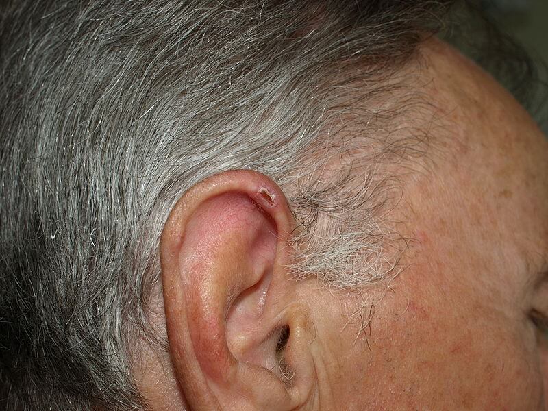 Chondrodermatitis helicis nodularis (67-year-old man)
