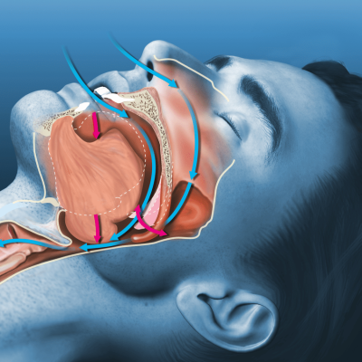 Sleep Apnea ICD 10 code